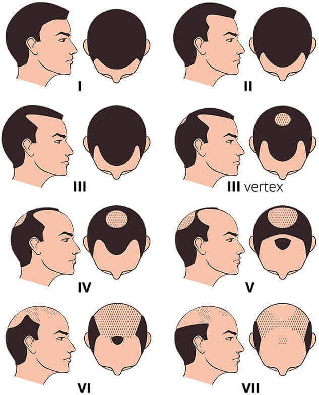 FUE Hair Transplant - Norwood Male Pattern Hair Loss