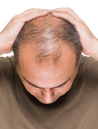 Affordable FUEHair Transplant - Hair Transplant Candidate