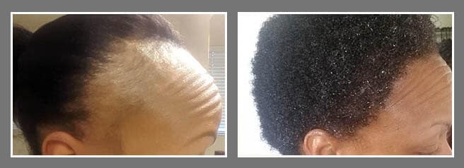 African American male before and after hair transplant results