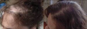 Female fue hair transplant before and after