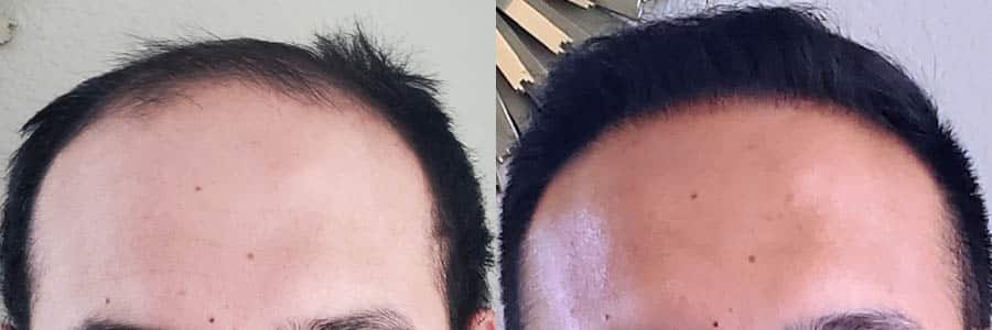 Male FUE Hair Transplants