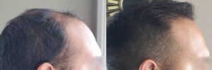 Male FUE Hair Transplants