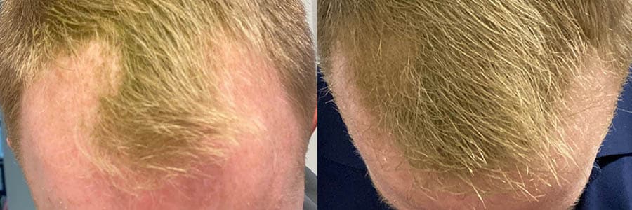 Male FUE Hair Transplant